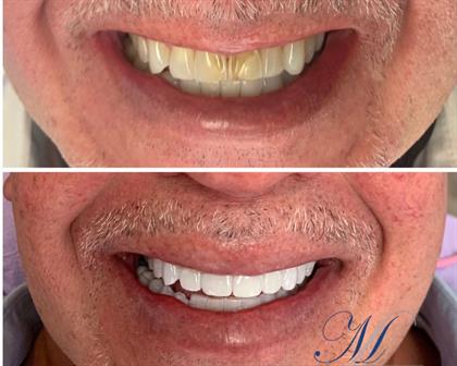 All About Tooth Whitening – Is it Worth It? · Miracle Smile Cosmetic Dentist